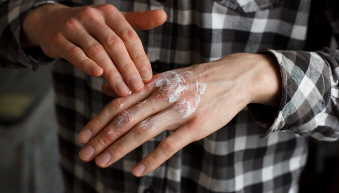 Как избежать проблем с кожей, к которым может привести частое мытье рук, использование дезинфекторов и перчаток